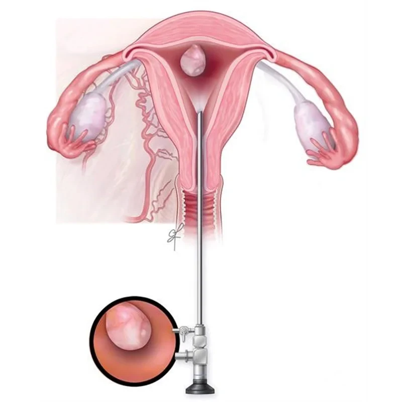 Hysteroscopy-2