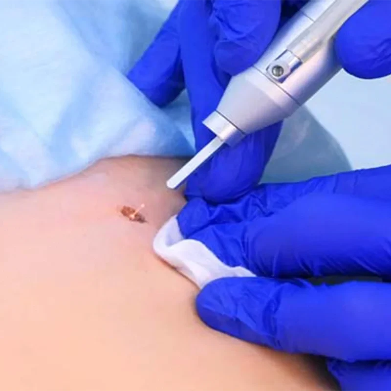 Laser-Wart-Treatment