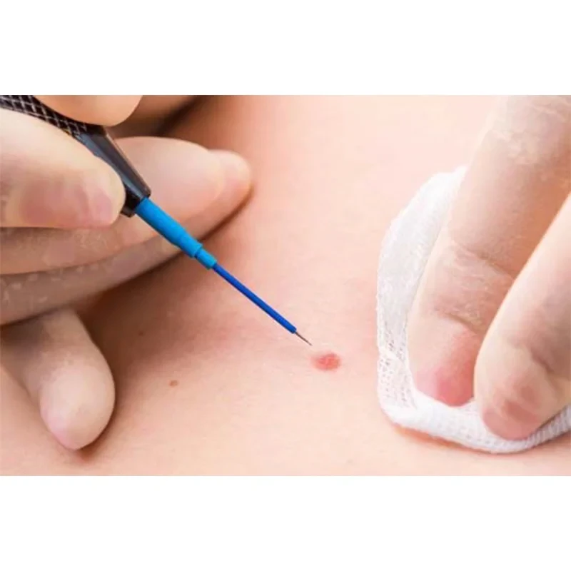 Radiofrequency Wart Treatment