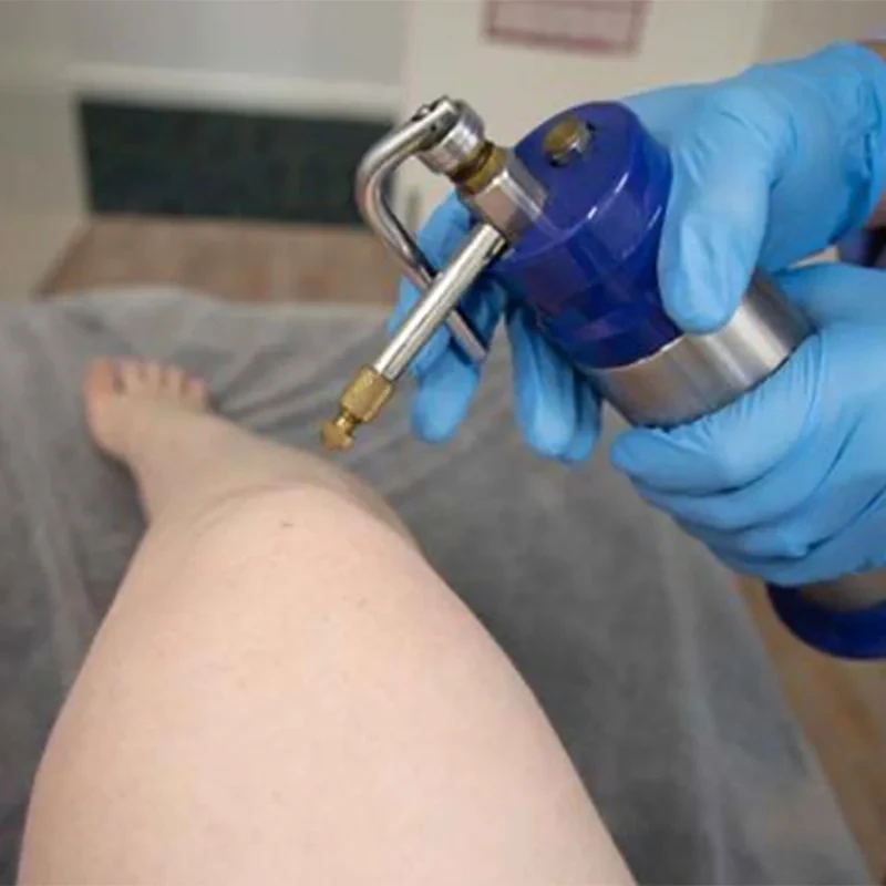 Cryotherapy Wart Treatment