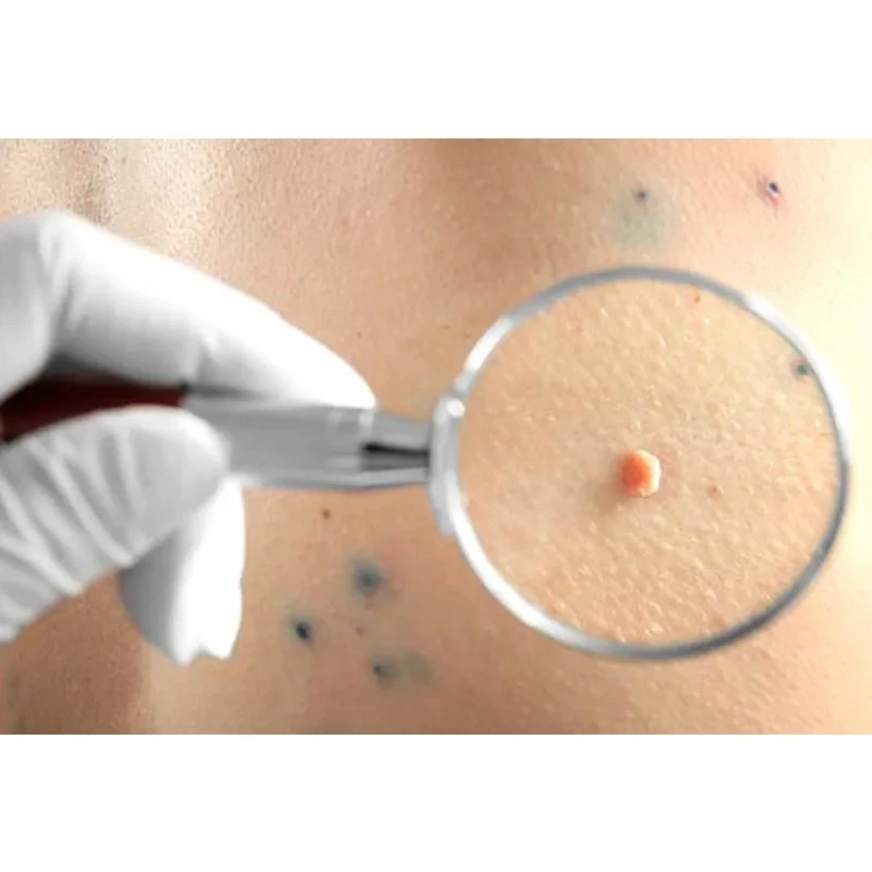 Wart-Treatment-Methods