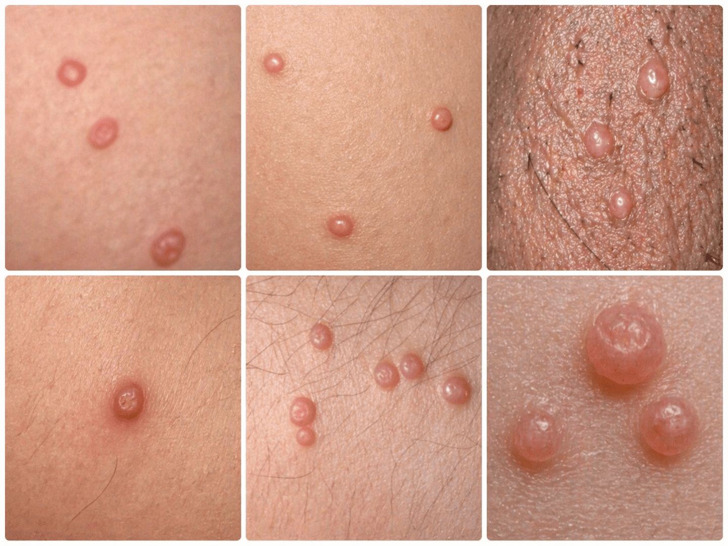 Molluscum Contagiosum Photo