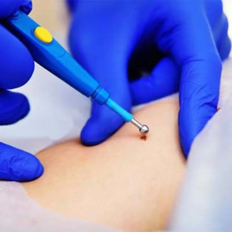 Cautery Wart Treatment