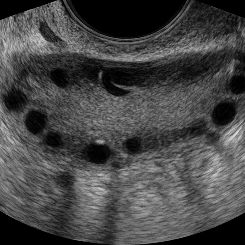 Pcos-Polikistik-Over-Sendromu
