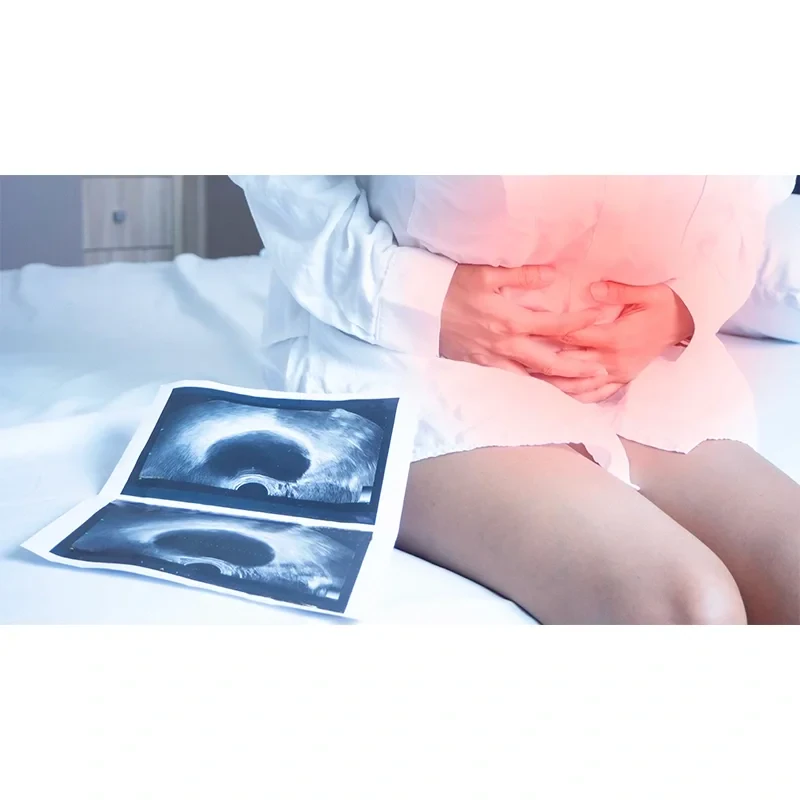 Ovarian-Cysts