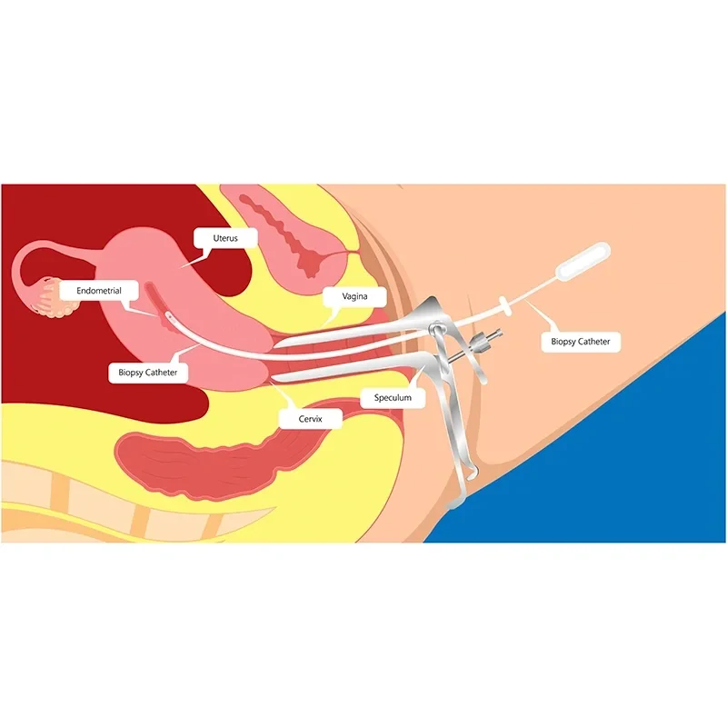 Endometrial-Biopsy