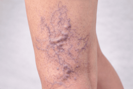 Varis Nedir? Neden Oluşur ve Kimlerde Görülür?