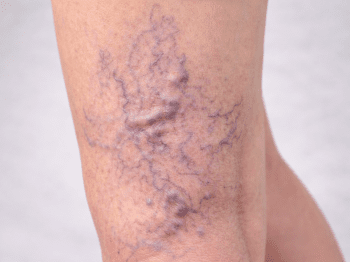 Varis Nedir? Neden Oluşur ve Kimlerde Görülür?