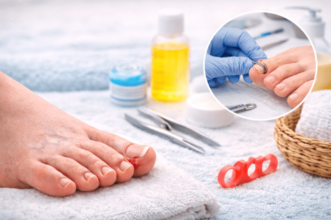 Tırnak Batmasında Alternatif (Ameliyatsız) Yöntemler Nelerdir?