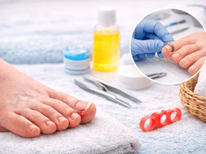 Tırnak Batmasında Alternatif (Ameliyatsız) Yöntemler Nelerdir?