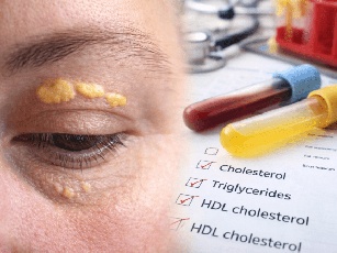 Ksantelazma (Göz Kapağında Sarı Plaklar) Nedir? Hangi Bölüm Bakar? RF ile Tedavi