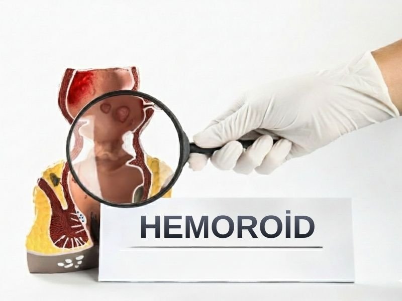 Lazerle-Hemoroid-Tedavisi-Avantajlari