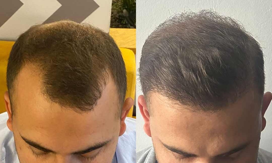 Sac-Ekimi-Once-Sonra-4