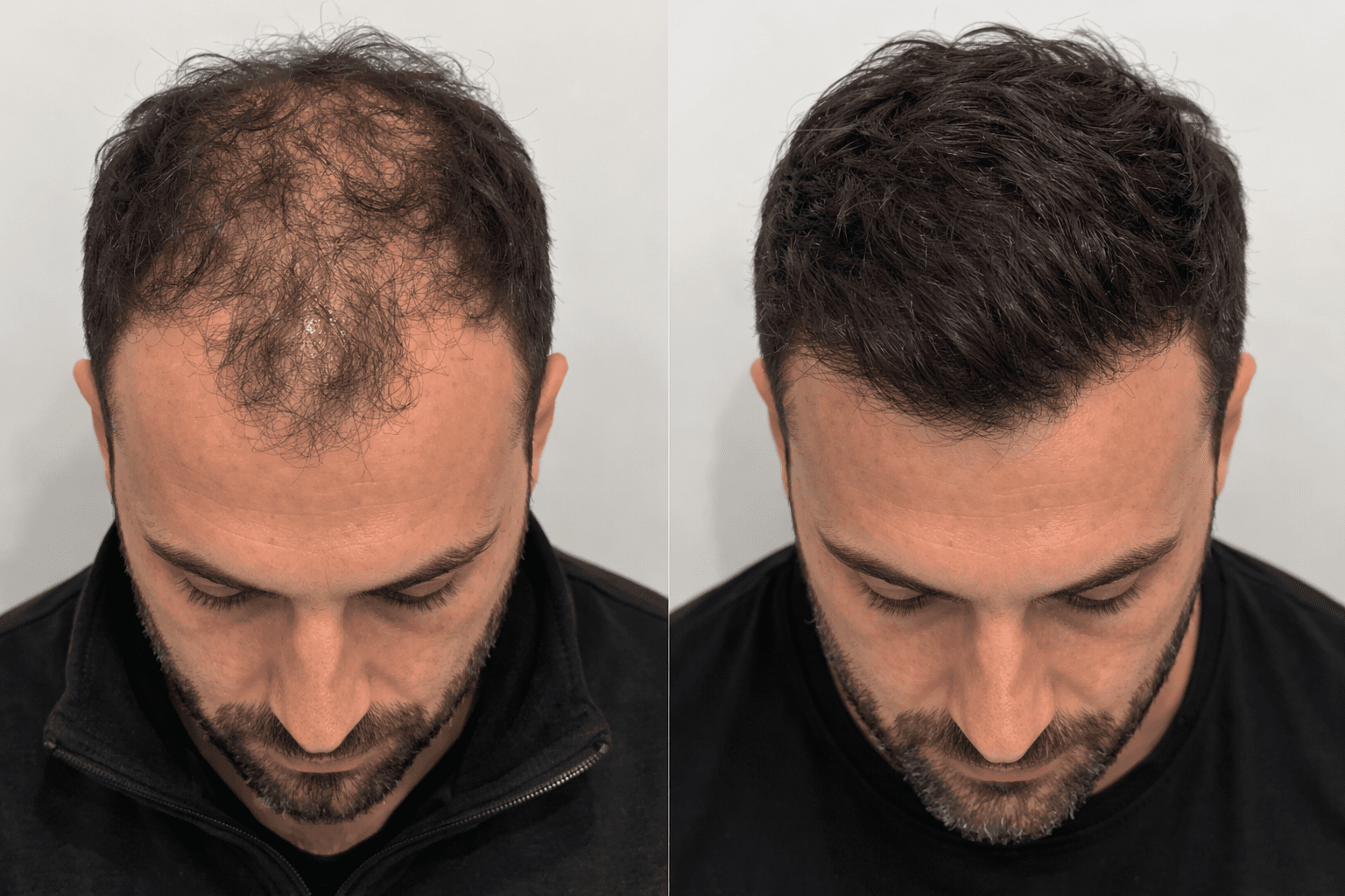 Saç Ekimi Öncesi & Sonrası