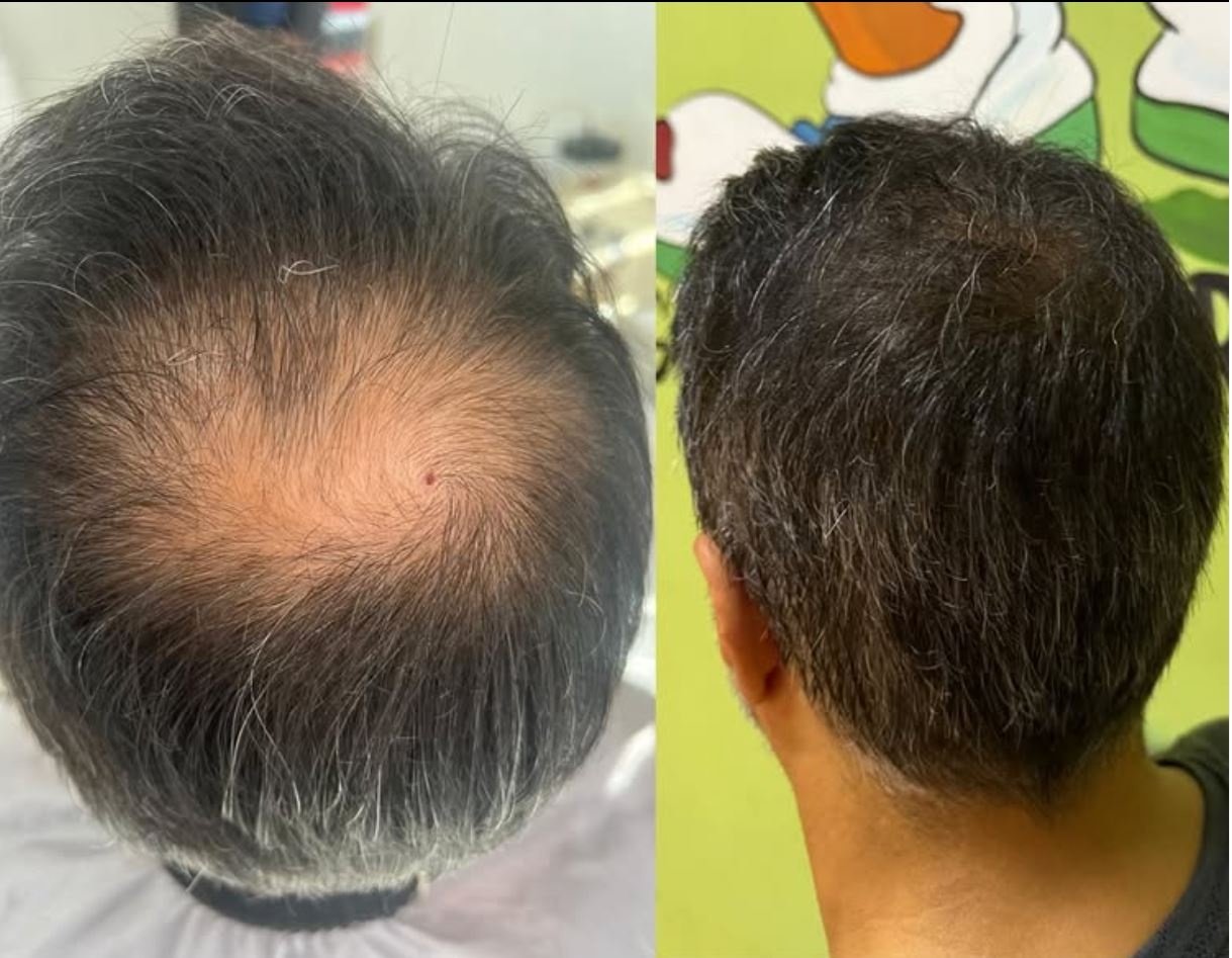 Saç Ekimi Öncesi & Sonrası