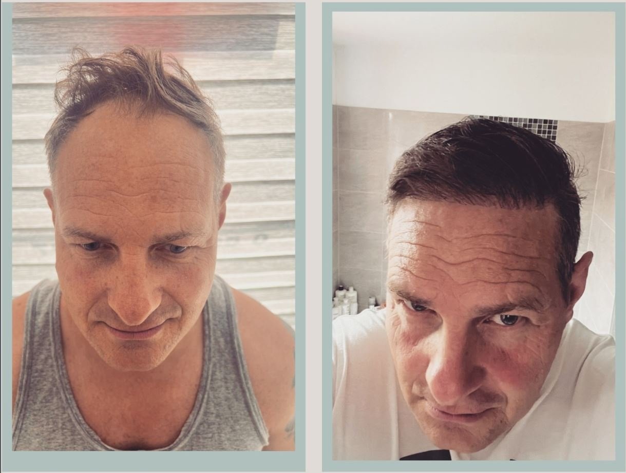 Saç Ekimi Öncesi & Sonrası