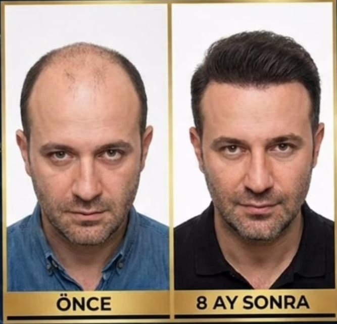 Saç Ekimi Öncesi & Sonrası