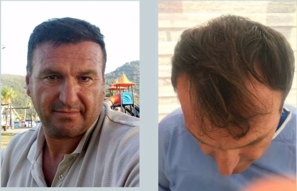 Saç Ekimi Öncesi & Sonrası