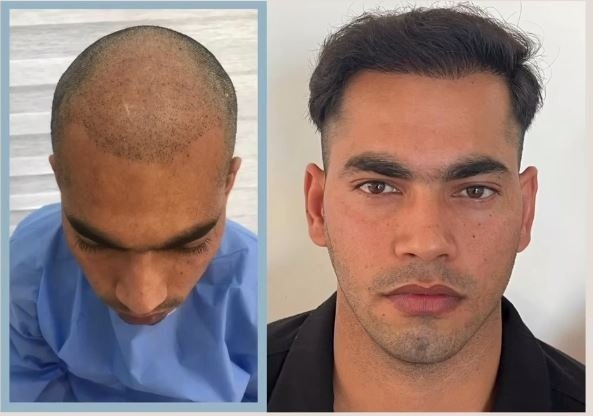 Saç Ekimi Öncesi & Sonrası