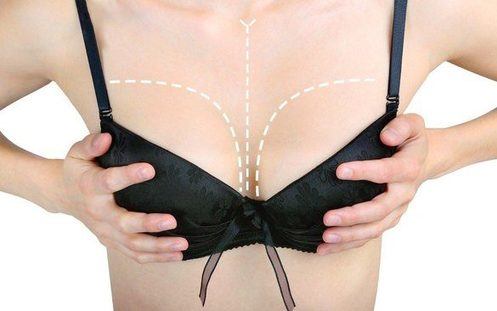Breast-Augmentation