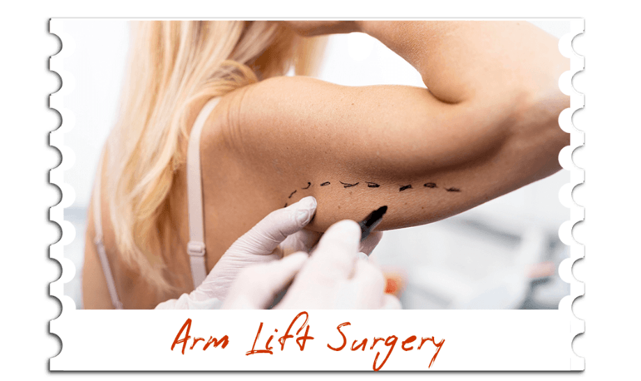 Arm Lift Surgery
