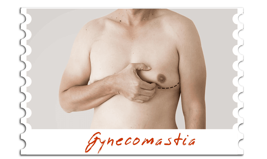 Gynecomastia