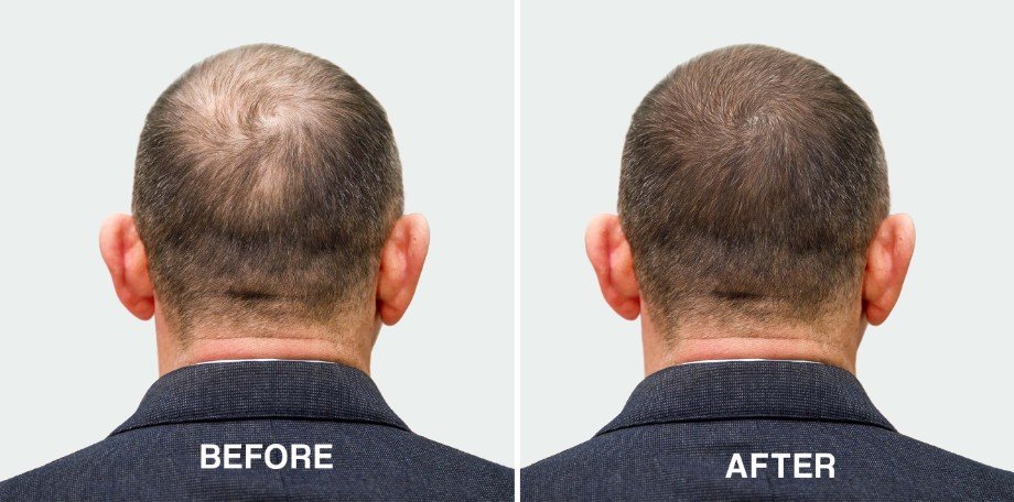 Hair Transplant - 1