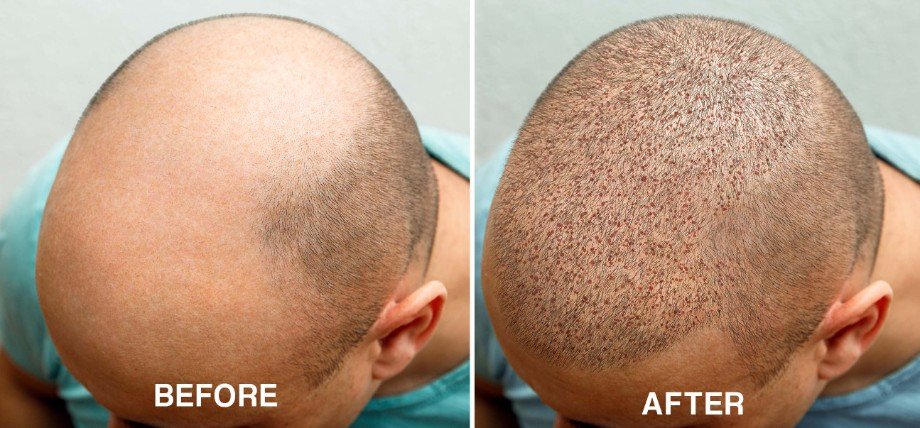 Hair Transplant - 2