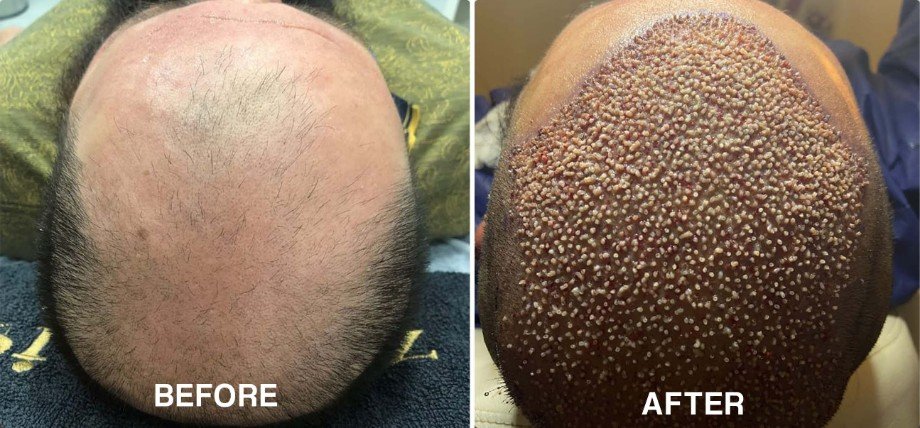 Hair Transplant - 3