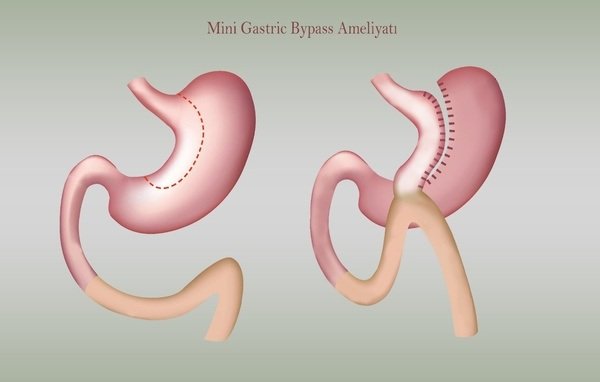 mini gastric bypass