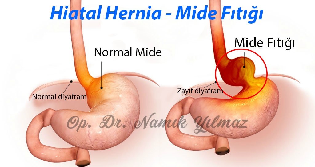 Mide_Fıtıgı_Dr_Namık_Yılmaz