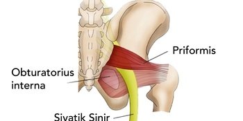 Priformis Sendromu ve Siyatik Sinir Ağrısı Nedir?