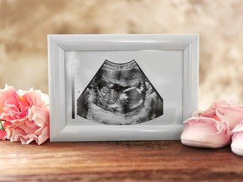 Is Egg Donation Religiously Permissible?